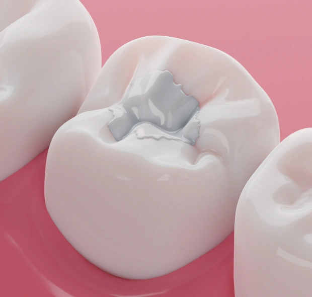 Repair Cavities and Restore Your Smile