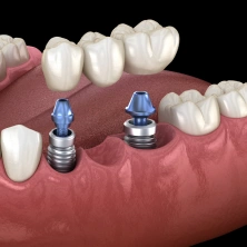 Implant-supported bridge