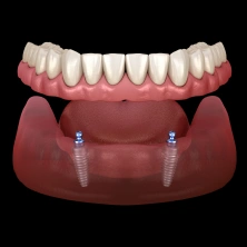 Implant Supported Dentures