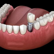Single tooth implant