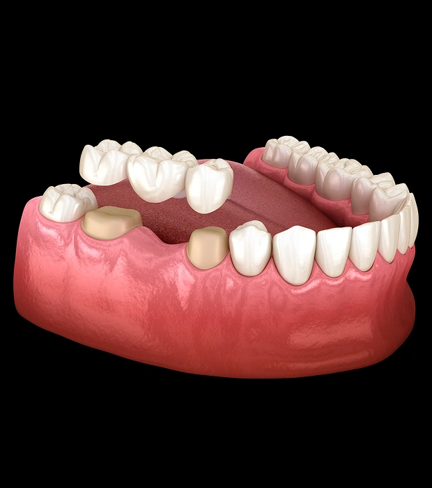 A Reliable Way to Complete Your Smile