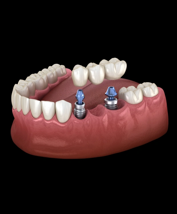 Restore Your Smile with a Permanent Tooth Replacement