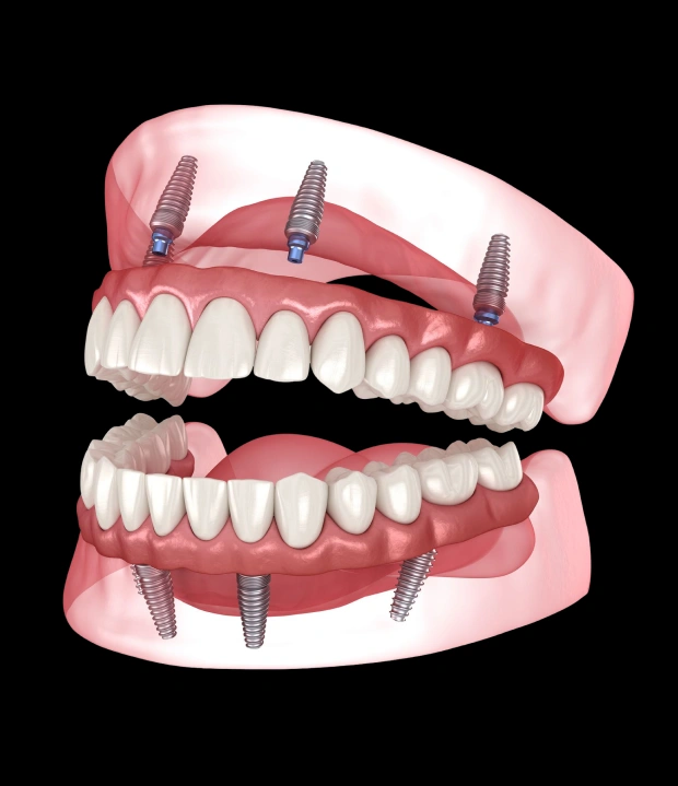 A Lasting Solution for a Complete Smile