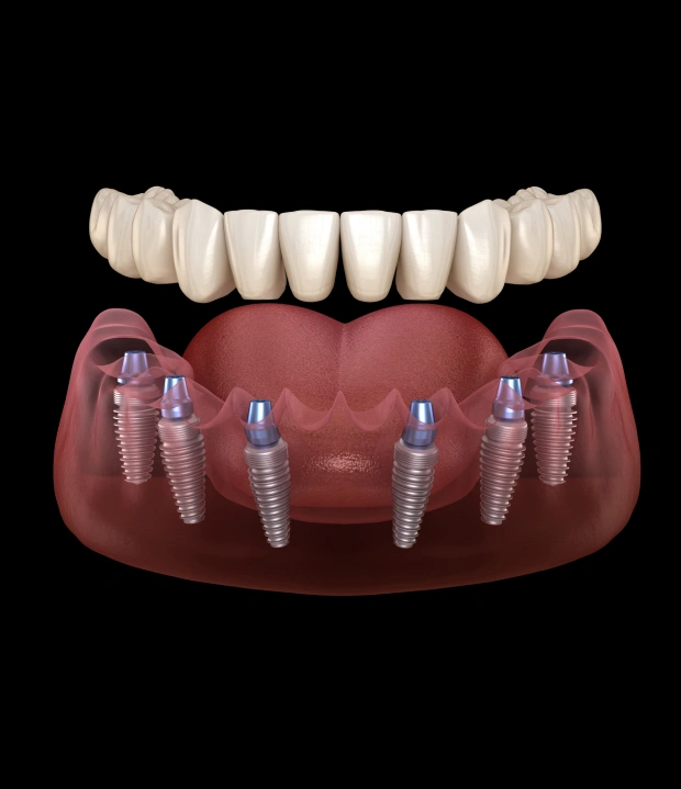 Full mouth dental implants