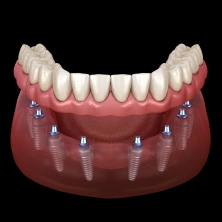 Full-mouth dental implant restoration
