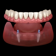 Implant-supported dentures with dental implants.